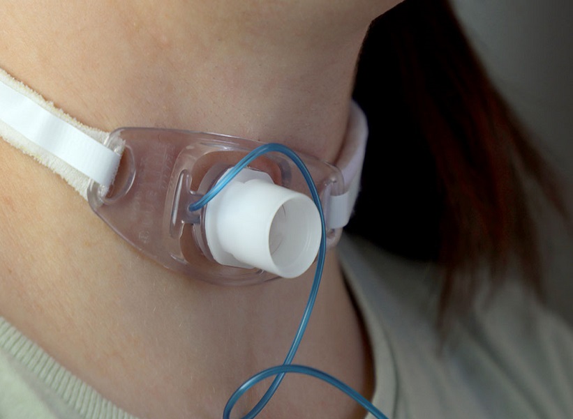 Tracheostomy Tube Change at Home in Mayur Vihar, Delhi